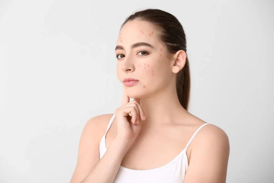 Cum să scapi de coșuri? 3 tratamente pentru acnee - Viorica Cosmetic MD