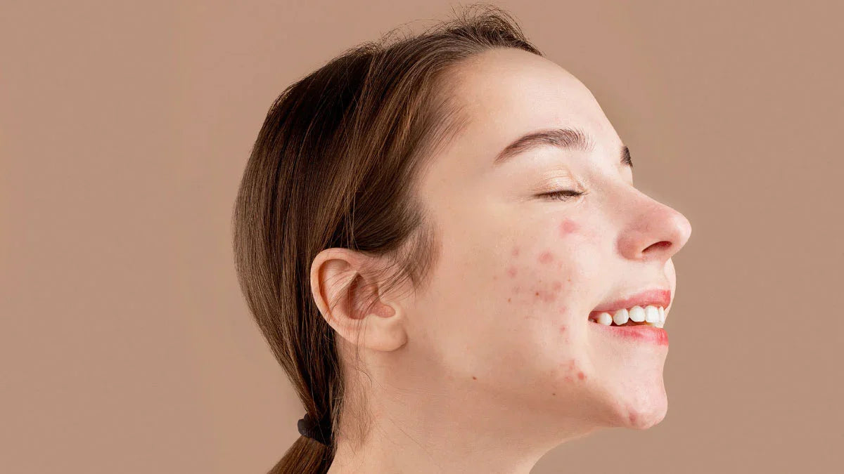 Acneea: mituri și adevăruri: ghidul complet pentru o îngrijire corectă - Viorica Cosmetic MD