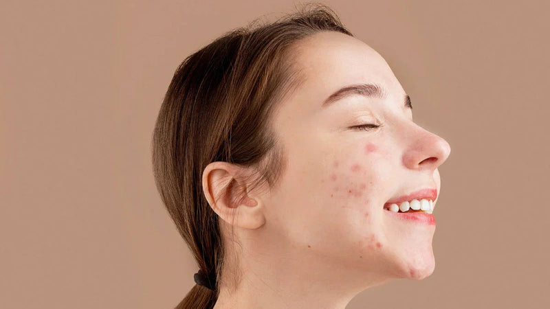 Acneea: mituri și adevăruri: ghidul complet pentru o îngrijire corectă - Viorica Cosmetic MD