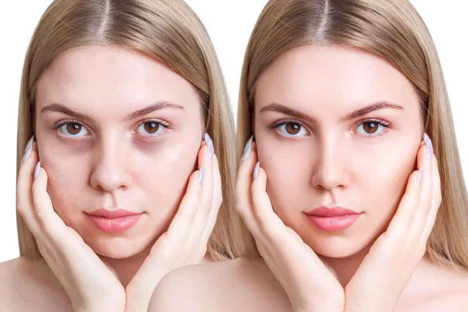 Cum scapi de cearcăne? 5 sfaturi și metode recomandate - Viorica Cosmetic MD